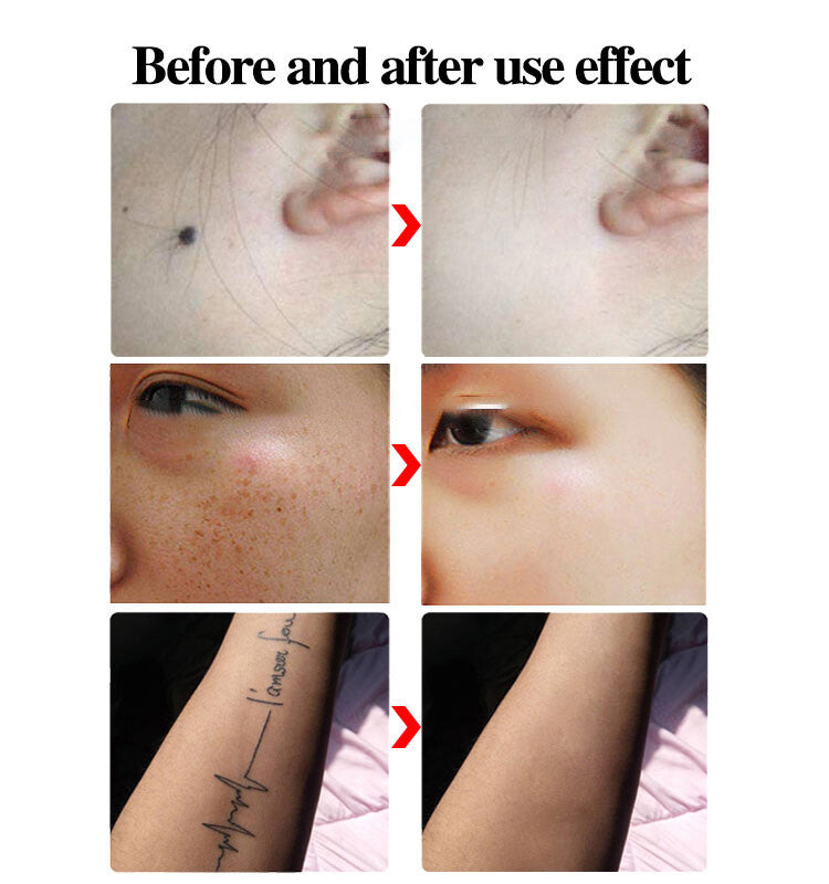 Black Red Blue Picosecond Pen Second Generation Handheld Portable Melanin Sweeping Pen for Face Mole Removal Picosecond Meter