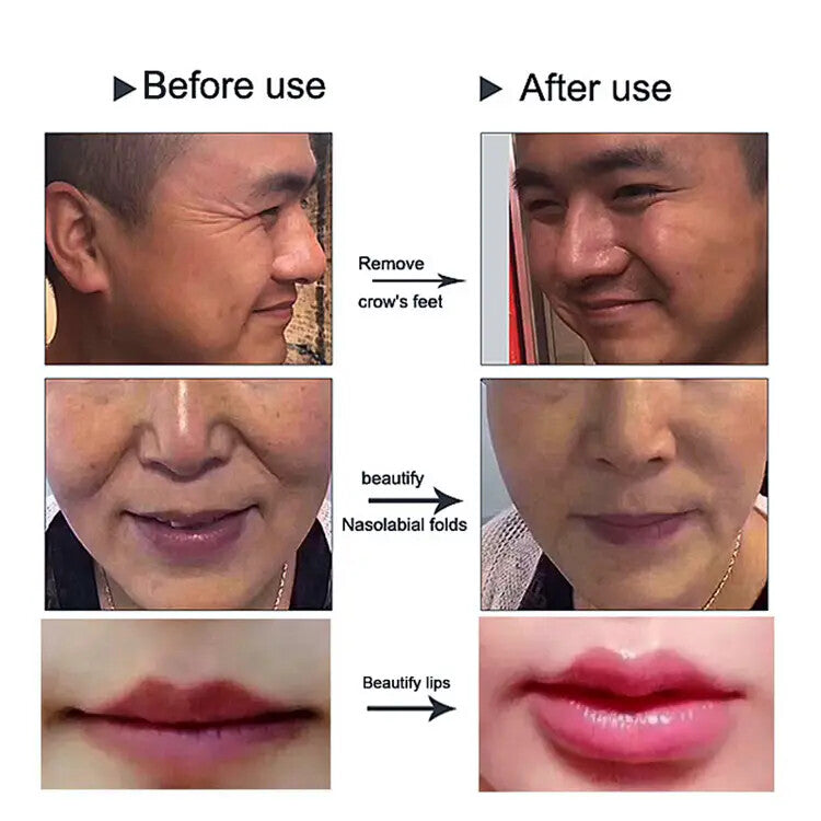 0.3ml 0.5ml 2 in 1 Head Hyaluronic Acid Dermal Filler Pen for Lips Enhancement Skin Rejuvenation Care Anti Wrinkle Spa Home Use