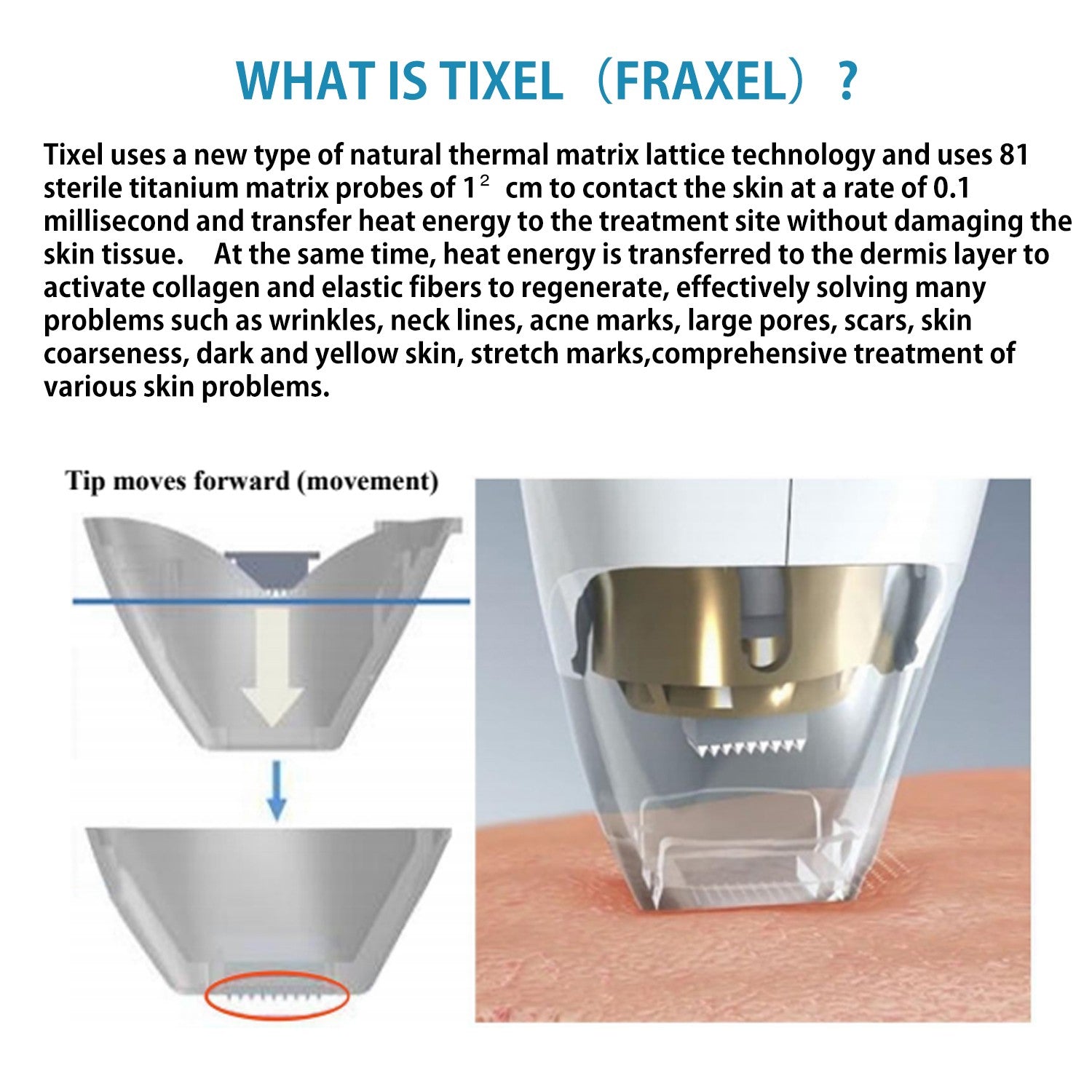 2 Handles Tixel Thermal Fractional Machine, Salon Skin Resurfacing Device for Stretch Mark, Scar & Wrinkle Removal Treatment