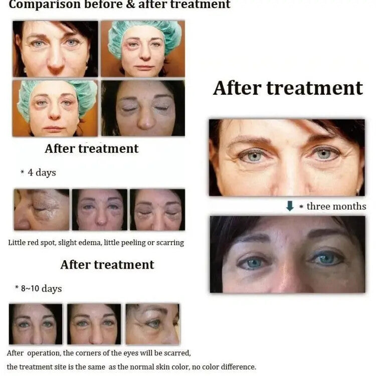 Portable 2 In 1 PAA Fibroblast Ozone Plasma Pen Face Eyelid Lift Wrinkle Removal Skin Care Device Home Use