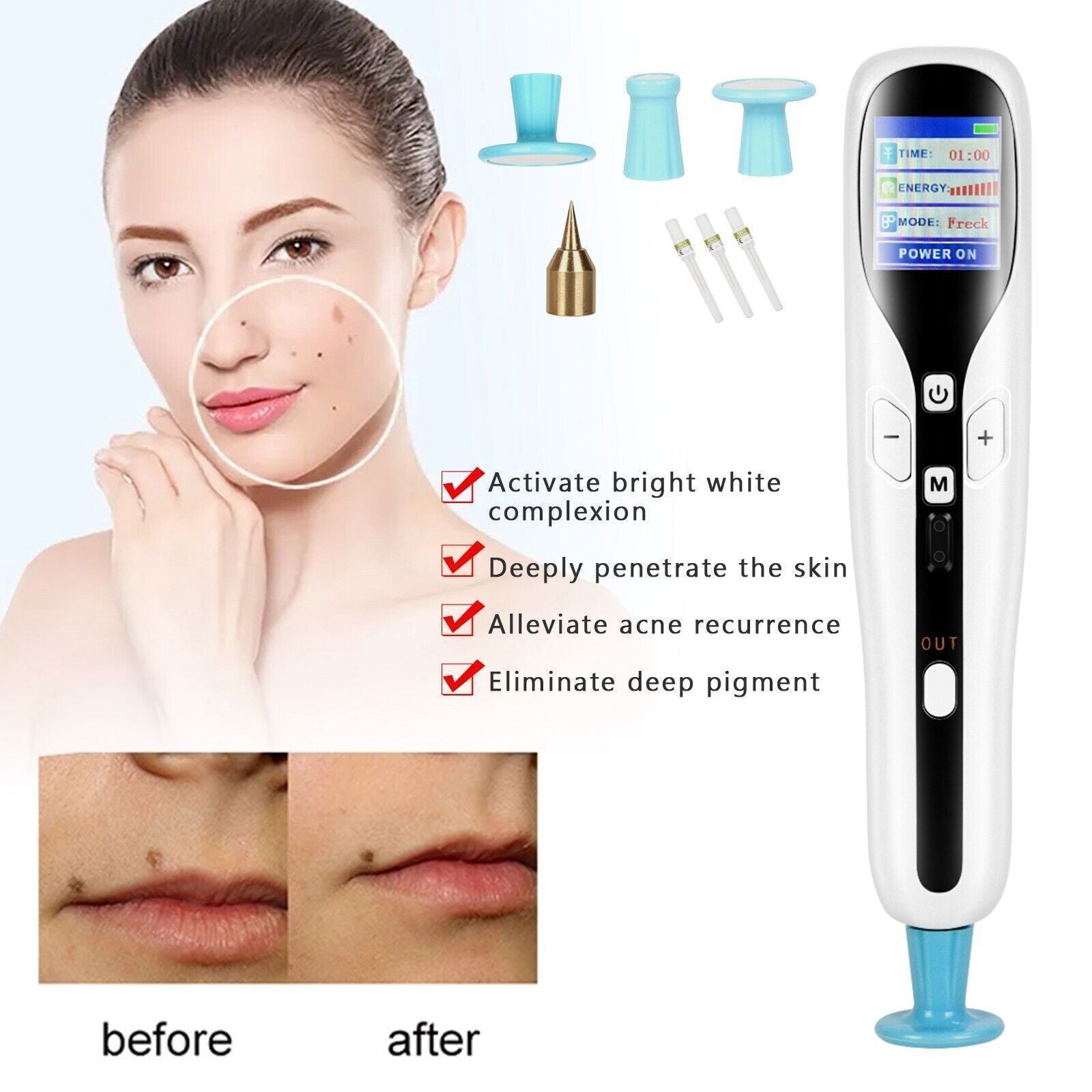 2 in 1 Ozone Plasma Mole Removal Pen for Body and Face Lifting Eyelid Lifting Plasma Pen