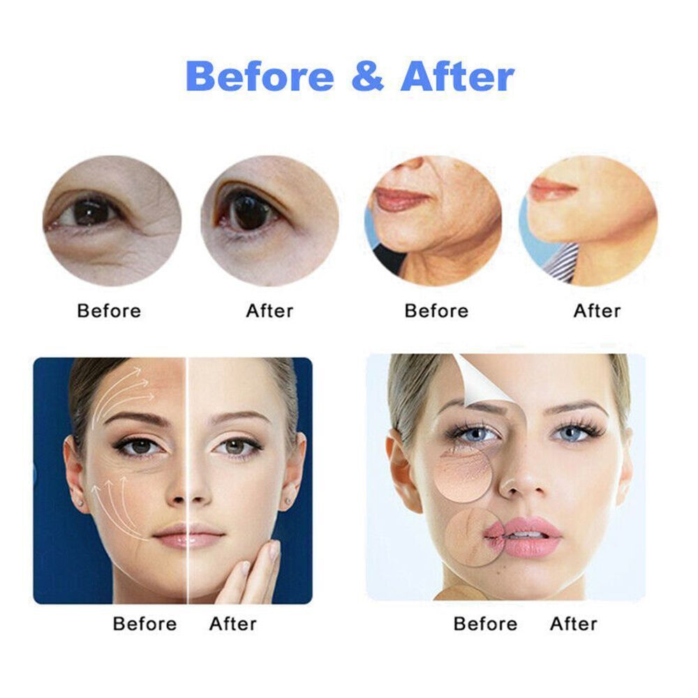 Professional Skin Tightening Rejuvenation Machine Lifting 1.5mm 3.0mm 4.5mm 8.0mm 13.0mm Cartridge 10000 Shots