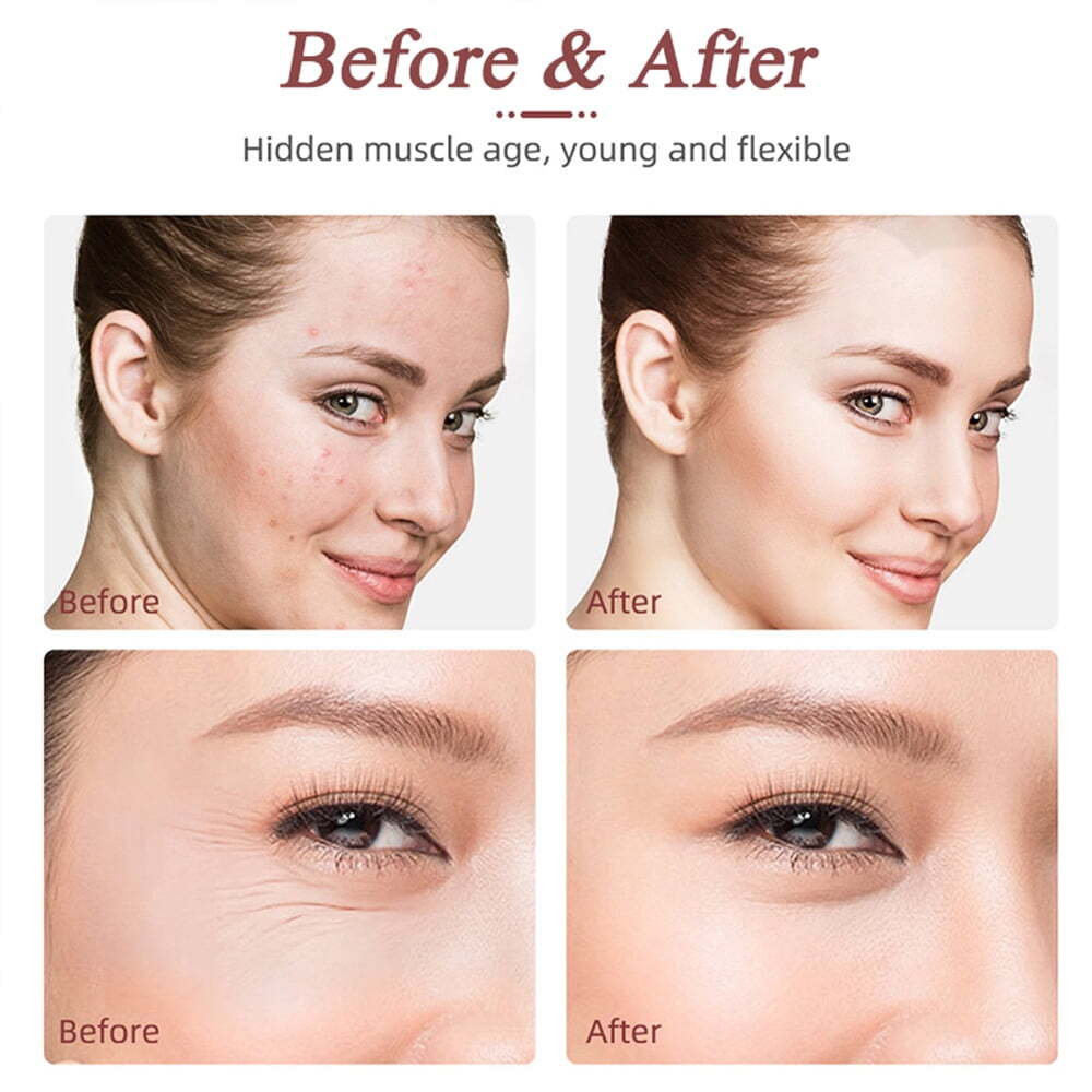 Mini HIFU RF Facial Skin Tightening Machine, Portable Radio Frequency Face Lifting Device for Wrinkle Reduction Skin Care