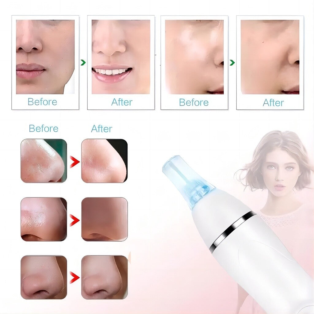 Diamond Microdermabrasion Blackhead Removal Vacuum Peeling Skin Rejuvenation Dermabrasion Facial Massage Beauty Device