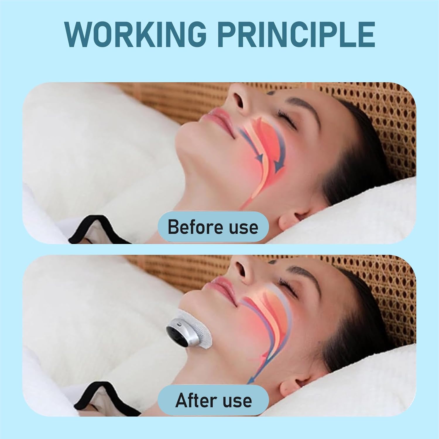 Z3 Pro Snoring Solution, Professional Anti-Snoring Device, 3-Speed Adjustment, Smart Snoring Solution, Breathe Easy, Anti Snore