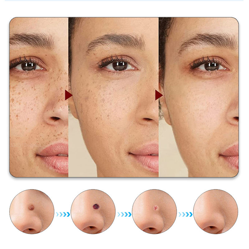 2 in 1 Ozone Plasma Mole Removal Pen for Body and Face Lifting Eyelid Lifting Plasma Pen