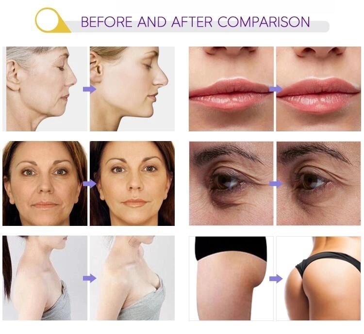 Painless Needle Free Injector Lip Plumper No Needle No Pain for Skin Tightening Face Lift Beauty