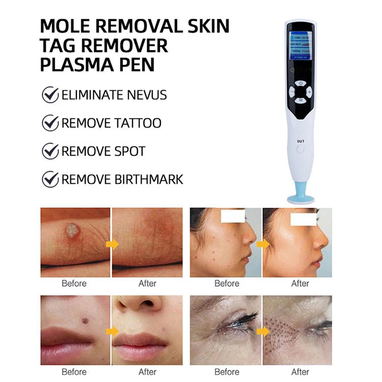 Portable 2 In 1 PAA Fibroblast Ozone Plasma Pen Face Eyelid Lift Wrinkle Removal Skin Care Device Home Use