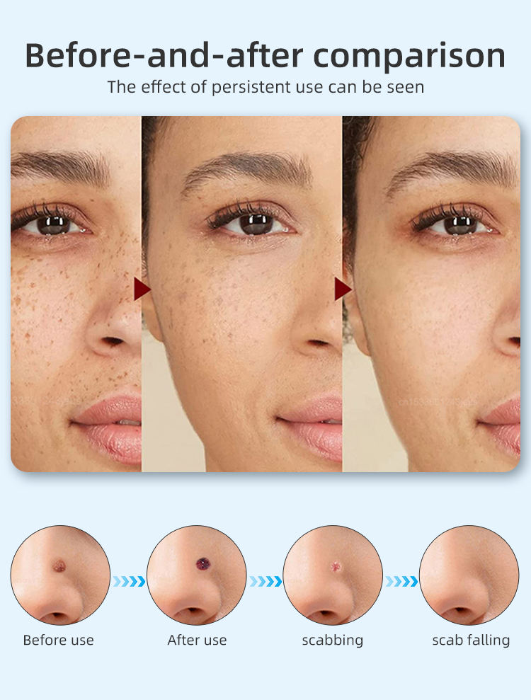 9-level Blue Light Mole Warts Removal Pen - Portable Beauty Instrument USB Charging Beauty Device