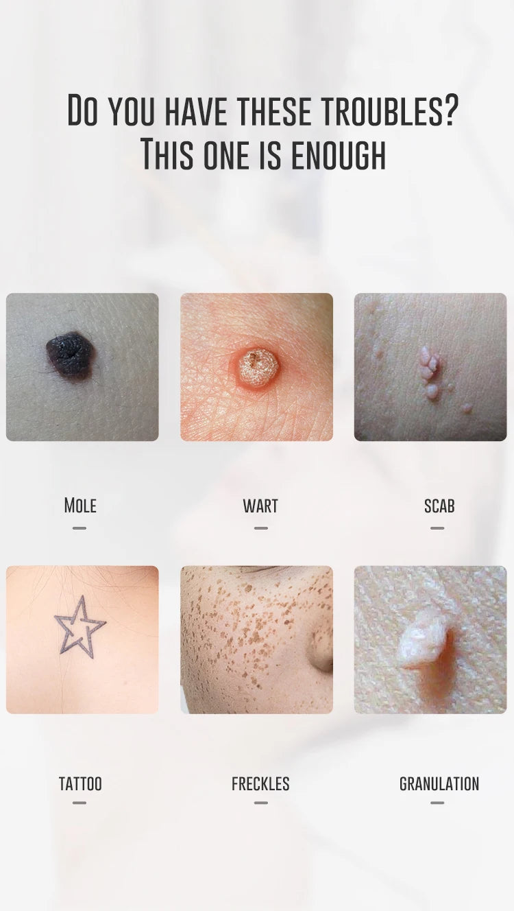Portable Rechargeable Tattoo Removal Device Mole Removal 9 Modes Bule Light or Red Light Picosecond Mini Laser Pen