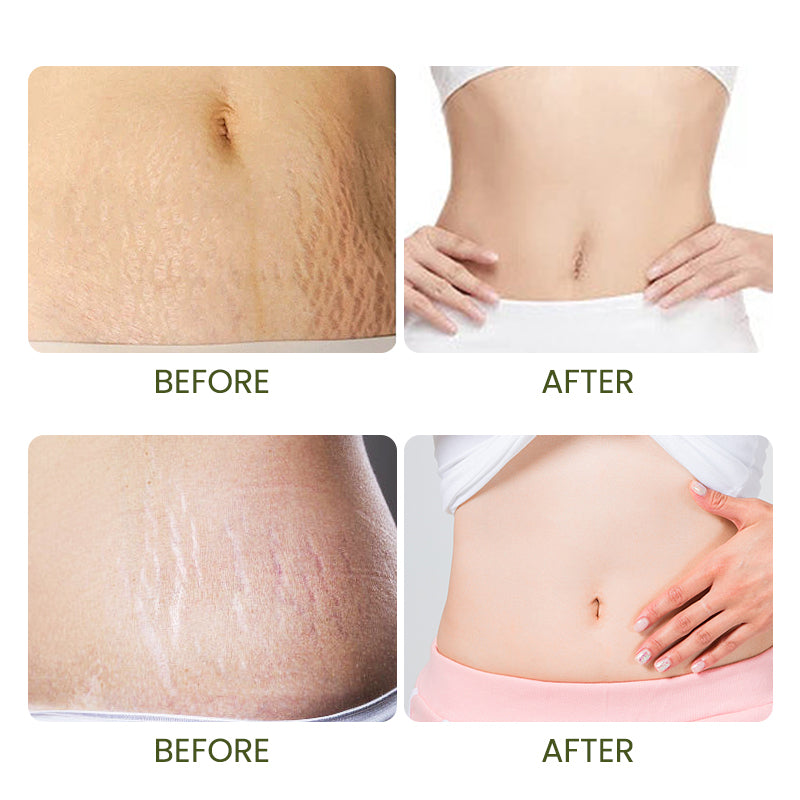 1PC Silicone Belly Sheet Reusable Self Adhesive Abdomen Skin Patch for Stretch Marks Care Anti Wrinkle