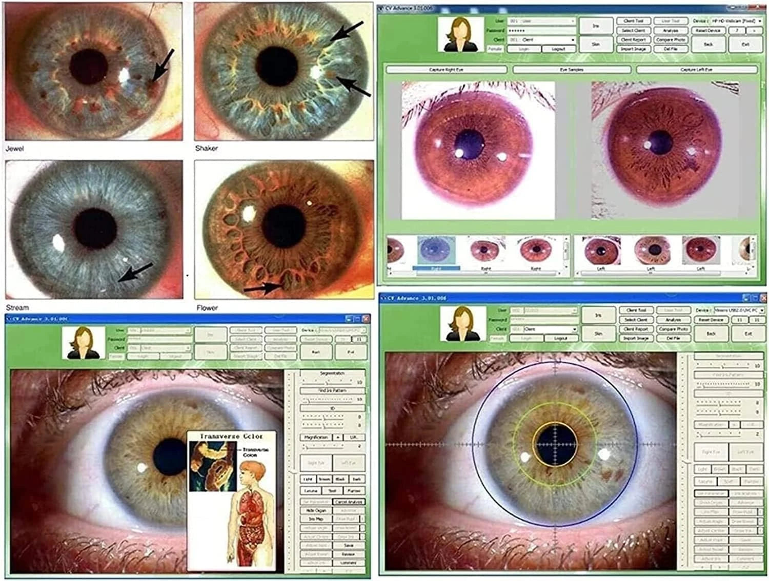 Iridology Camera Chart 5 MP HD 30X Iriscope 9809 Iris CCD Analysis V 3.31 Digital Iriscope Analyzer Iridology Appliance