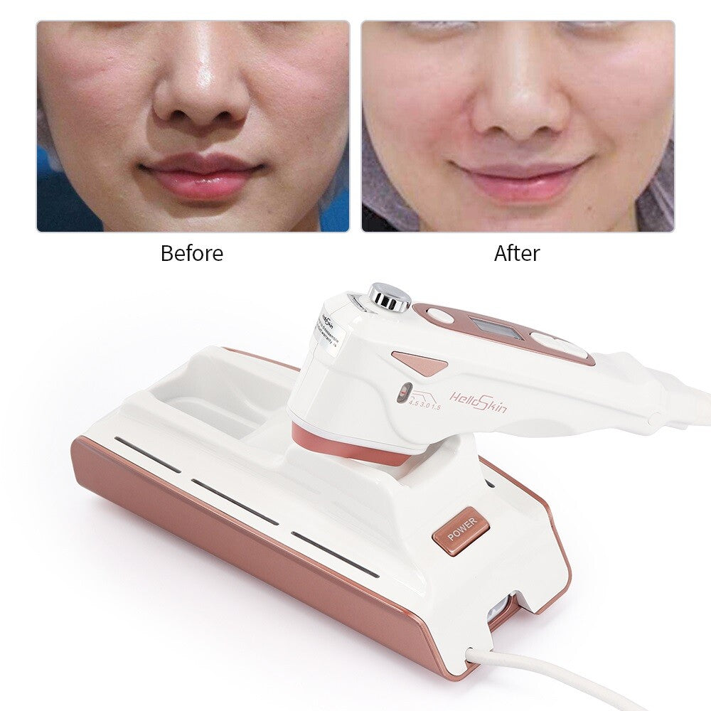 Mini Hifu Beauty Massager Face Lifting Skin Tightening Anti-aging Wrinkle Fat Removal Machine for Spa Salon and Home Use