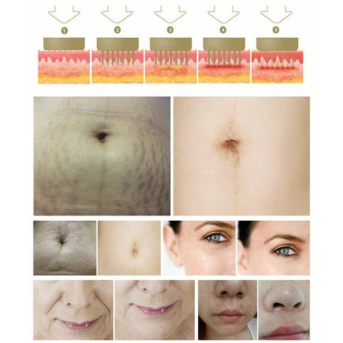 5/10/20 PCS Disposable Micro Green Cartridge Needles 10/25/64 Nano Chip for RF Fractional Skin Care Beauty Machine