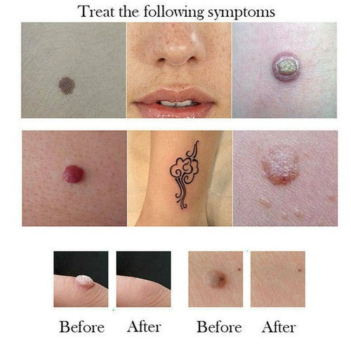 2/6pcs/10 Tips Cartridges Part Accessory Kit for Beauty Monster Plasma Pen Machine Wrinkle Freckle Dark Spots Removal