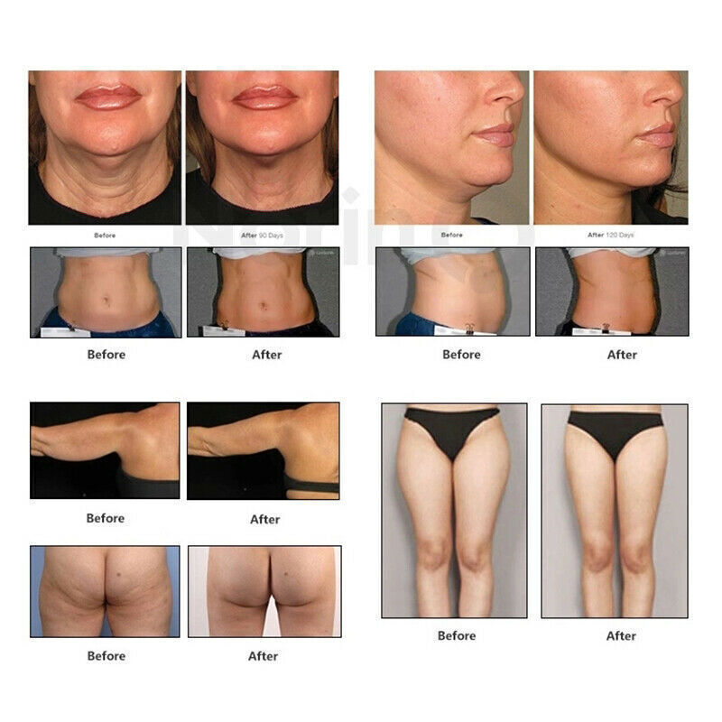 Portable Face & Body Lifting Skin Rejuvenation Machine Wrinkle Remove Skin Tightening Machine
